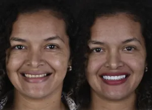 Diseño de sonrisa en Valledupar y Barranquilla - Dr. Maya