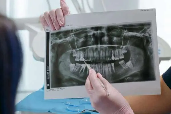 IMPLANTES DENTALES