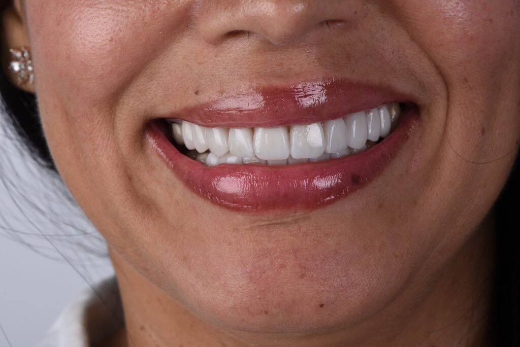 Paso a Paso del Diseño de Sonrisa