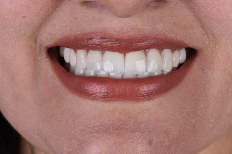 ¿Eres Candidato a un Diseño de Sonrisa?