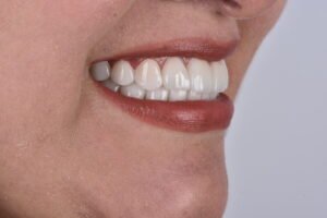 Diseño de Sonrisa y Mordida Saludable