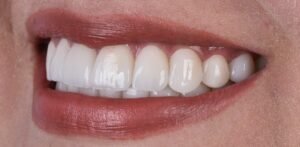 Diseño de Sonrisa Sin Tallar